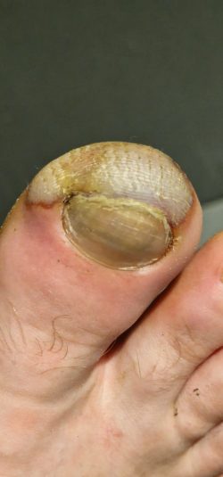 Night of the initial cold injury.